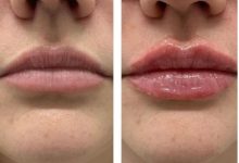 Where Can I Find Lip Flip Before and After Results in Torrance